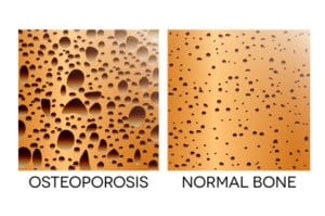 osteoporosis bone density & coeliac disease