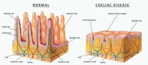 coeliac disease damaged villi